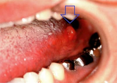 舌にも扁桃腺があります 舌の奥のぶつぶつしたもの 八島歯科クリニック