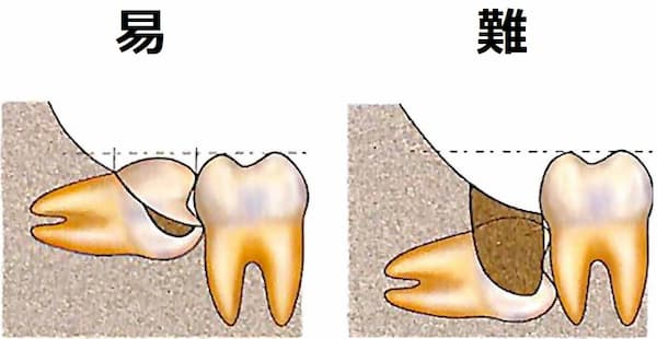 親知らずを抜くべきかどうかの判断基準と抜歯の難易度判定 八島歯科クリニック
