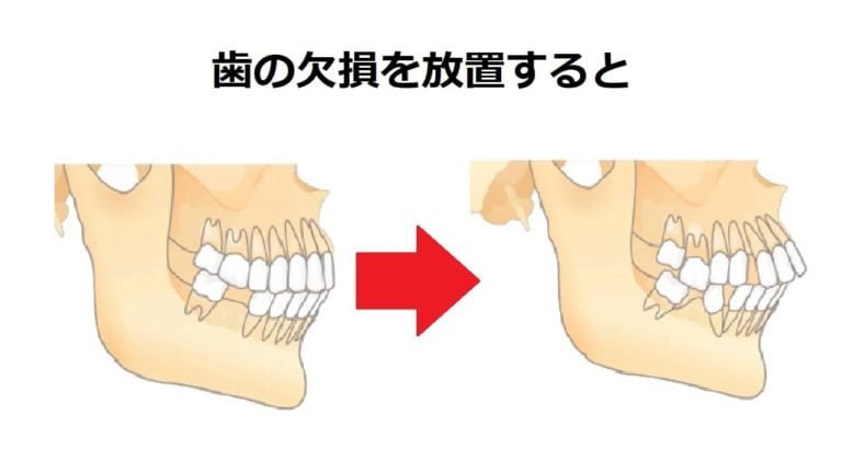 奥歯 欠け た 放置