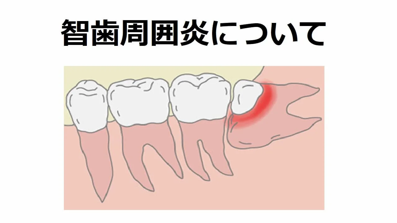 智歯周囲炎についての記事のアイキャッチ画像
