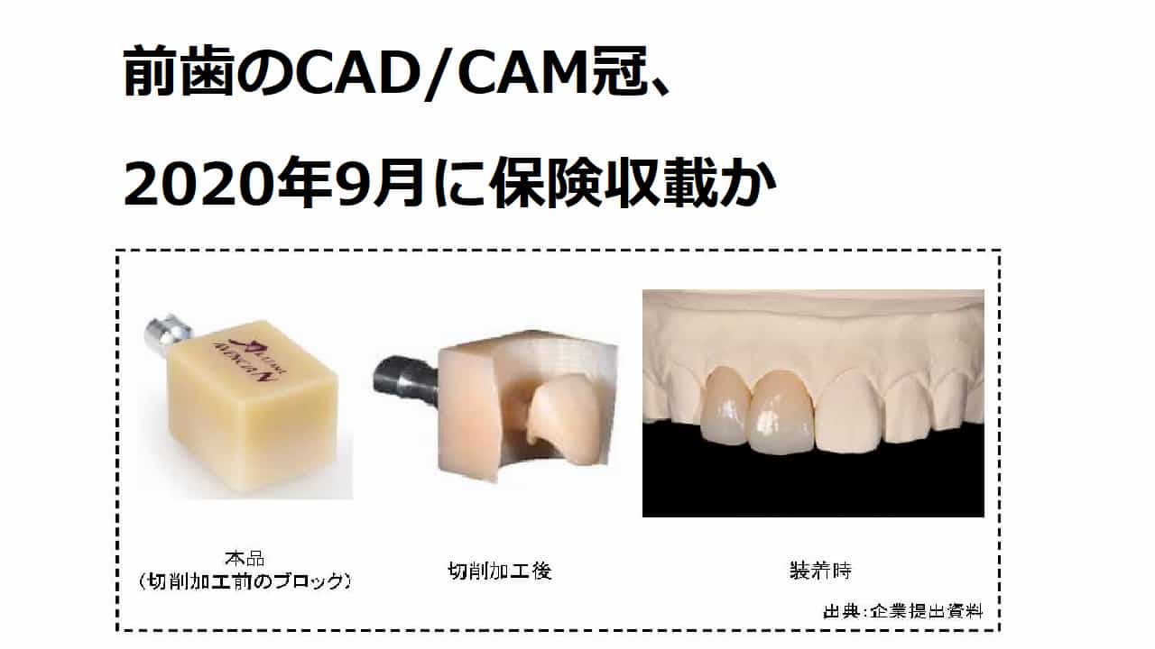 前歯のCAD/CAM冠、ついに保険適応か
