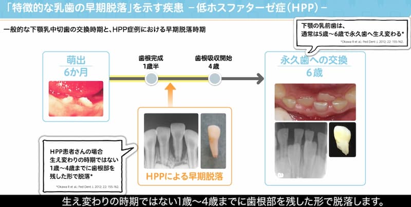低ホスファターゼ症による歯の早期脱落
