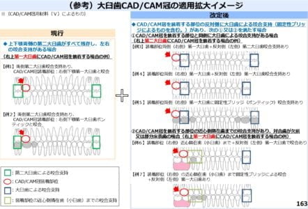 保険治療で出来る白い被せ物｜CAD/CAM冠 | 八島歯科クリニック