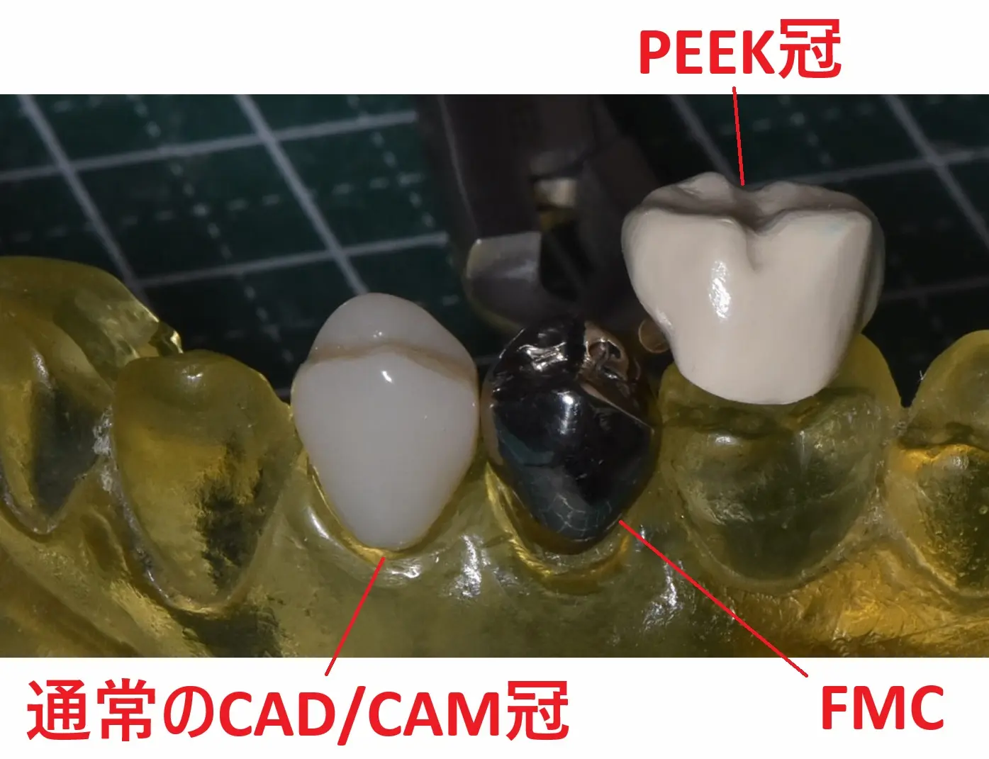 PEEK冠（Ivory色）と、通常のハイブリッドレジン製のCAD/CAMとFMC（保険の銀歯）を並べて比較した写真