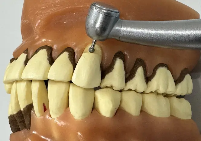 虫歯を削り取っている写真