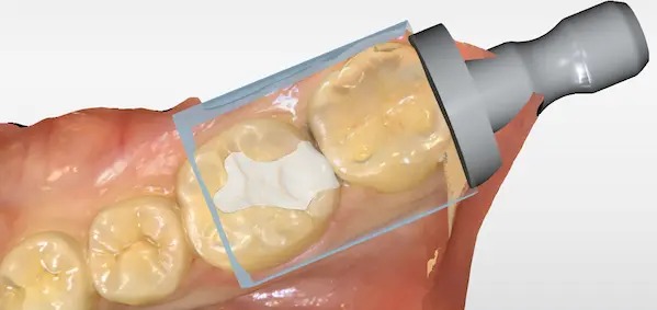 金歯　端材　インレー ⑯22g インレー アンレー 歯の詰め物 銀歯 金歯 金床 デンタルケア